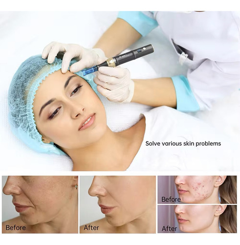 Dr Pen A8s Dermapen Última Tecnología Inalámbrico + 10 Rep