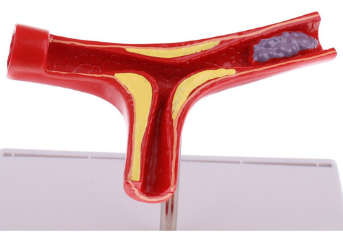 Modelo De Vascular De Trombo De Aterosclerosis De Vaso