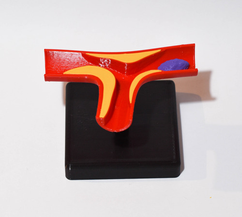 Maqueta Arteria Con Ateroma Semi Oclusivo - Medicina 3d