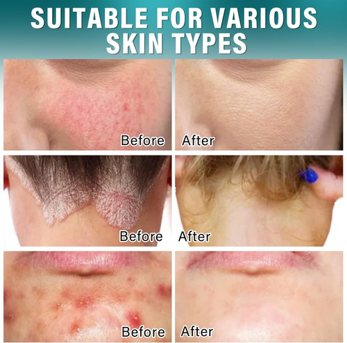 Dijkoo Crema De Foliculitis, Tratamiento De Foliculitis Para