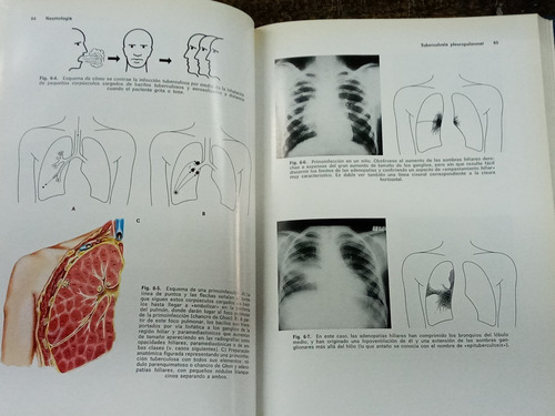 Neumologia * A. Agusti Vidal * Atlas Para El Medico * Salvat