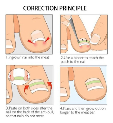 Parches De Corrección De Uñas Pies Encarnadas. Herramienta