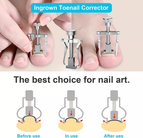 Kits Profesionales Para Cortar Uñas Y Enterradas Uñas