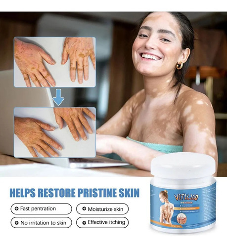 2 O Creme De Vitiligo Elimina Manchas E Marcas Brancas