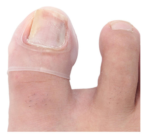 Corrección De Uñas Encarnadas Del Del Pie Cuidado De Los