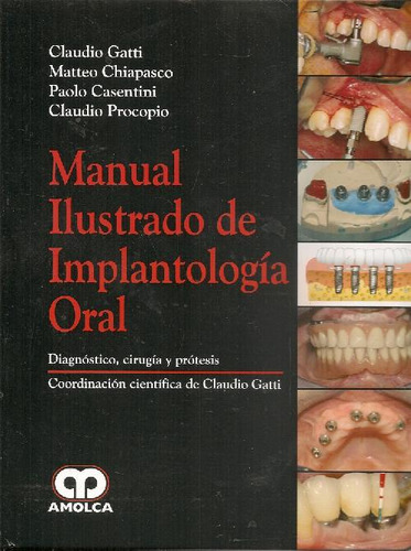Libro Manual Ilustrado De Implantología Oral De Matteo Chiap