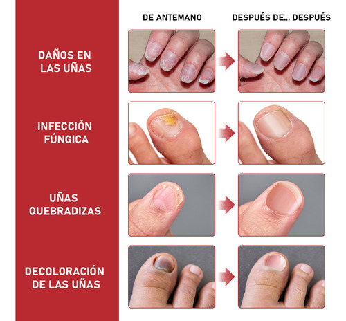 Dermfree Para Uñas Gruesas, Dañadas Y Decoloradas 30ml