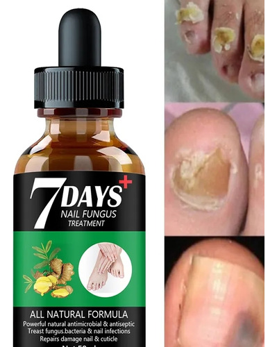 Tratamiento En Uñas Pie Con Hongos Onicomicosis Serum 10 Ml