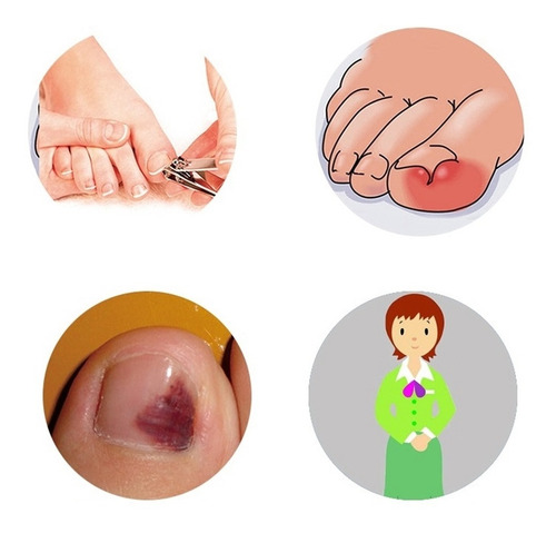 12x Pinzas Encarnadas Para Enderezar Las Uñas De Los Pies C