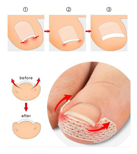 100 Pegatinas Correctoras Para Uñas Encarnadas