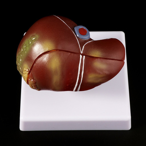 S Fígado Humano Patológico Anatômico Modelo Anatomia Escola