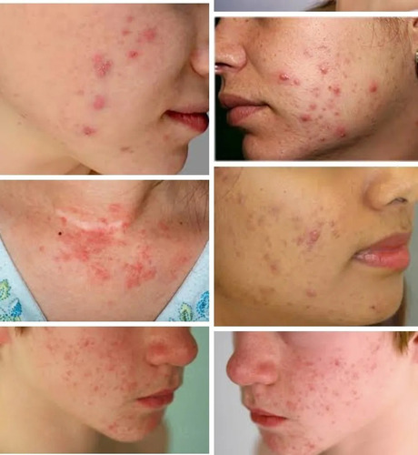 Jabon Para Psoriasis, Caspa En La Piel, Ácaros, Alergias