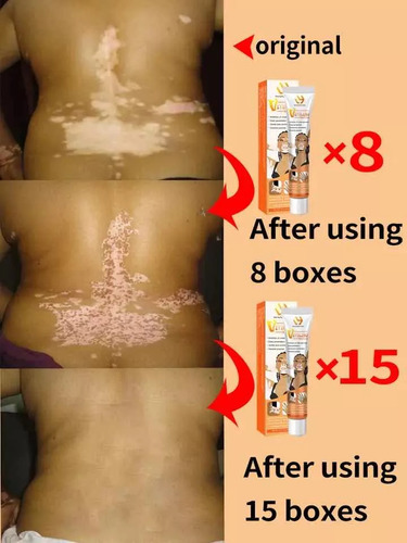 Crema Tratamiento Profesional Para Eliminar El Vitiligo Original