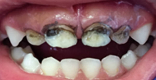 Imagen 6 de 7 de Fagamín Fluoruro Diamino Plata Dental 5ml Santiago