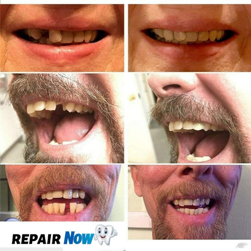 Dentadura Cosmética Postiza Termomoldeables Agnovedades