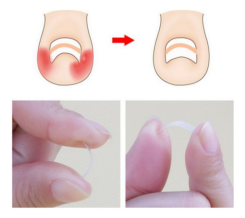 20 Piezas Profesion Uña Encarnada Del Pie Uñas Manicura