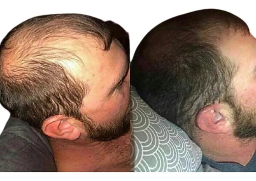 Barba Tónico 500 Gotas + Serum Capilar 120 Ml + Envio