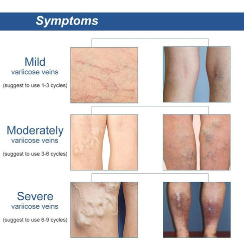 10 Parches Para Tratamiento De Varices. Desinflama Y Alivia