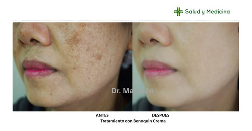 Crema Blanqueadora Para Despigmentar La Piel Benoquin Neutra