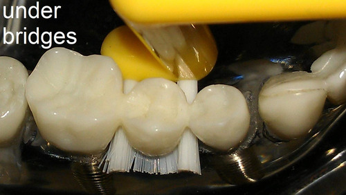 Cepillo De Dientes Implantclean Modelo Suave Para Implantes Color
