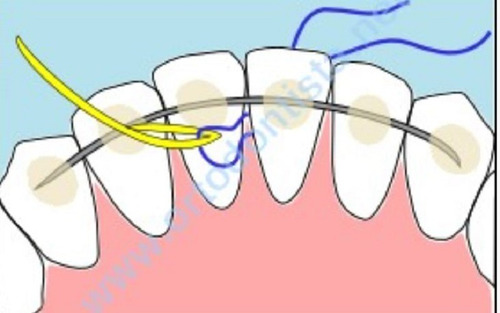 Passador De Fio Dental Aparelho Ortodôntico E Prótese Fixa