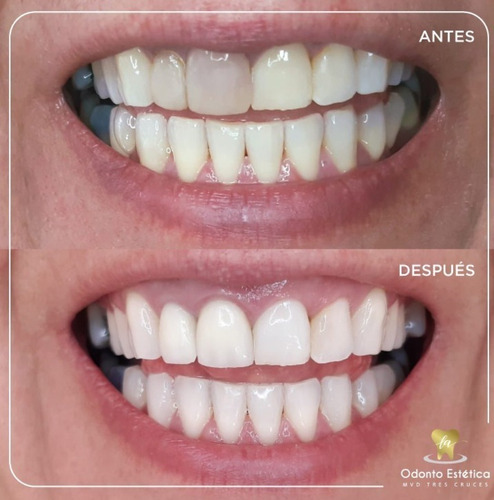 Dentista - Prótesis Dentales - Implantes - Extracciones