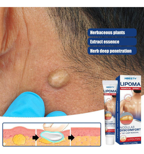 - Crema Para Eliminar Lipomas, Crema Limpiadora De Lipomas.