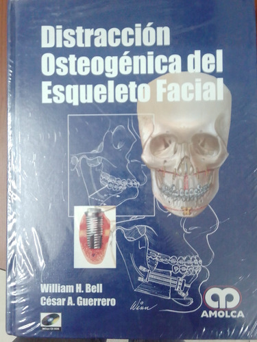 Distracción Osteogenetica Del Esqueleto Facial Bell Amolca