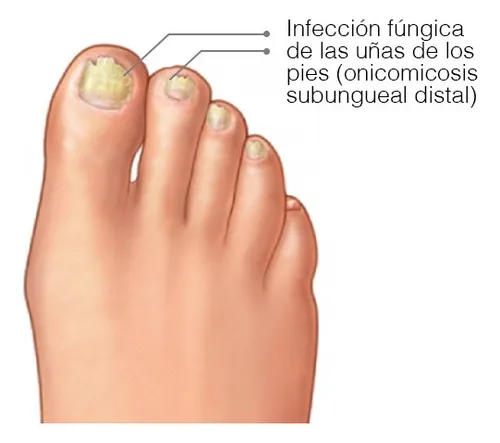 Gotas Hongos Pie De Atletas