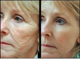 Imagen 2 de 6 de Remodelacion Facial Con Acido Hialuronico. 098 173 504