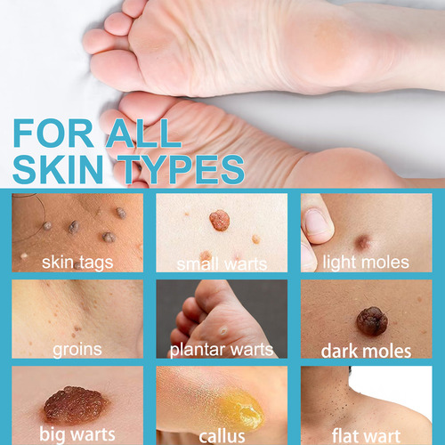 Caneta De Remoção De Verrugas Para Remover Caneta Para