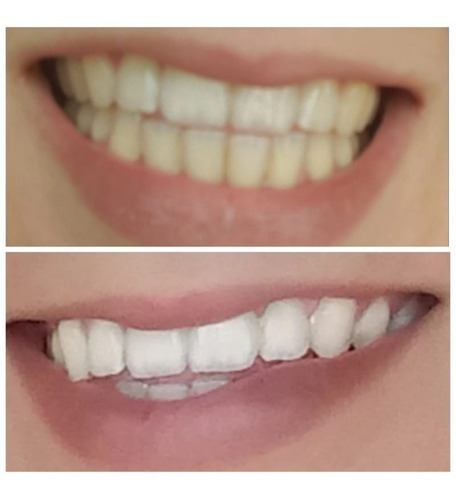 Blanqueamiento Dental Sparkling White Smiles 28 Tiras