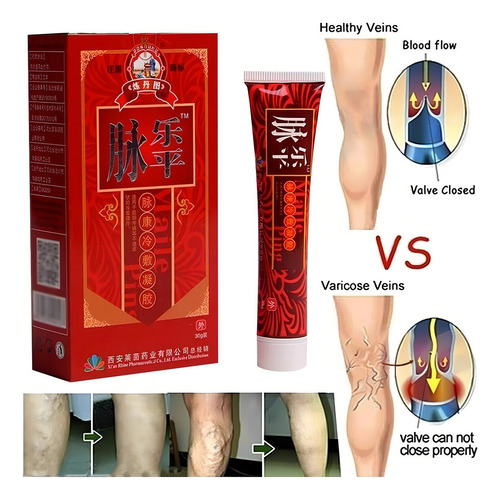 Creme Chines Tratamento De Varizes Veias Da Perna 30g