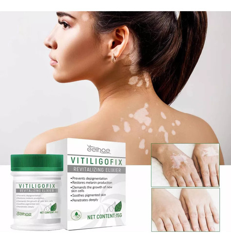 . Pomada Blanca Para El Vitíligo, Crema Para La Micosis, Leu