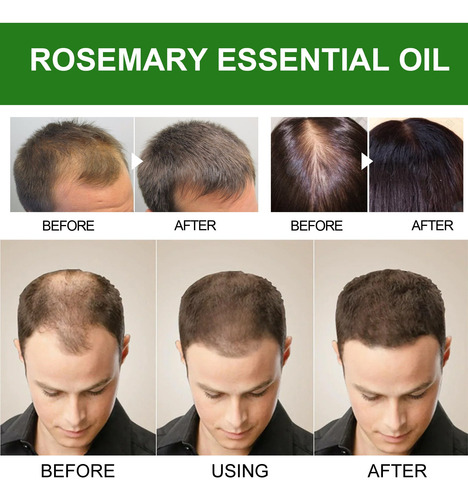 Eelhoe Aceite De Romero Set Tratamiento Para Cabello Seco