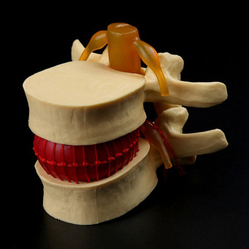 Modelo De Vértebras Lumbares: Columna Anatómica Hernia D