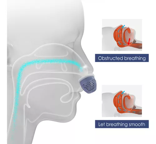 Venta Internacional-Dispositivo Electrónico Antirronquidos Micro Cpap Para  Apnea