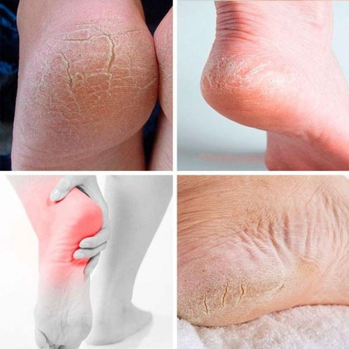 Imagem 4 de 4 de Skin Rejuvenescedor Para Pés - Frete Grátis Internacional