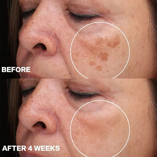 Crema Facial Blanqueadora Y Eliminadora De Melanina.