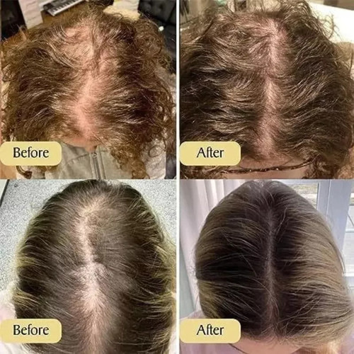 4pcs Aceite Esencial Para Cuidado Del Cabello Veganic Hair