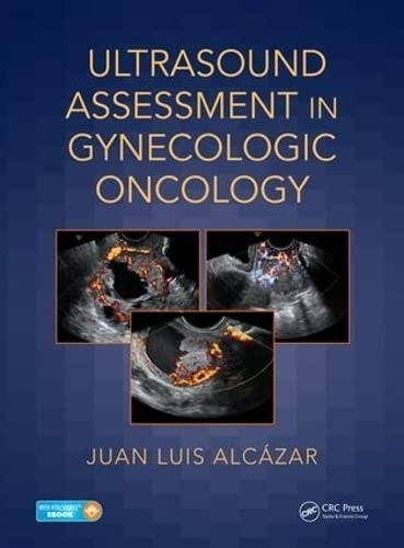 Ultrasound Assessment In Gynecologic Oncology - Alcázar Zamb