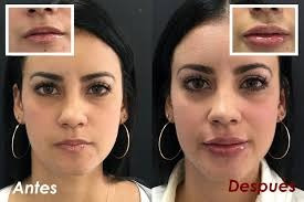 Imagen 4 de 6 de Remodelacion Facial Con Acido Hialuronico. 098 173 504