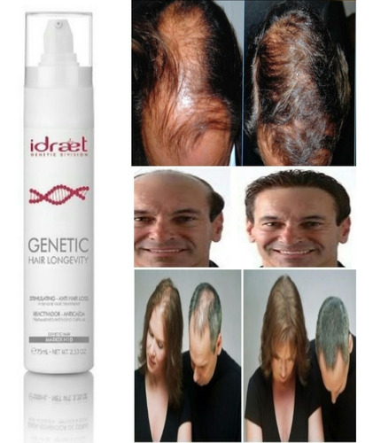Imagen 9 de 10 de Idraet Locion Caida Cabello Genetic Hair Loss Control Out