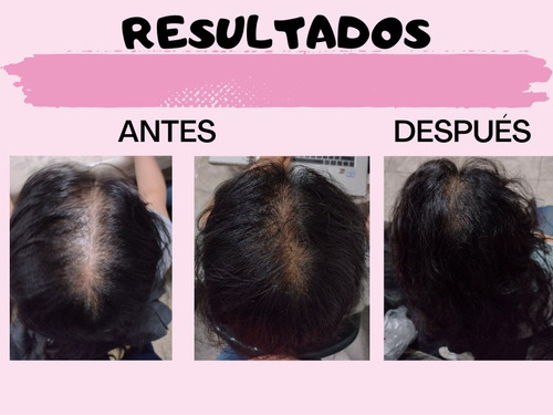 Tratamiento Anticaida 125ml/loción Estimulador Crec Cap130ml