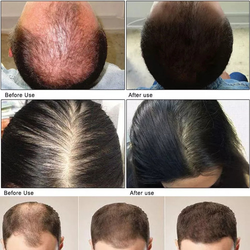 6*scalp Hair Serum For Hair Growth