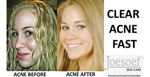 Joesoef Skin Care Jabón De Azufre Para Acné Dermatólogos De