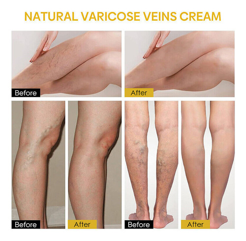 Crema Reparadora De Venas Varico Con Veneno De Abeja.2pc