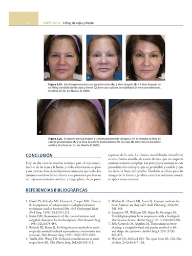 Procedimientos En Dermatología Cosmética.lifting Quirúrgico.
