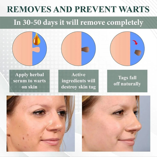 Gel Eliminador Instantáneo De Lunares Y Manchas, Gel Elimina