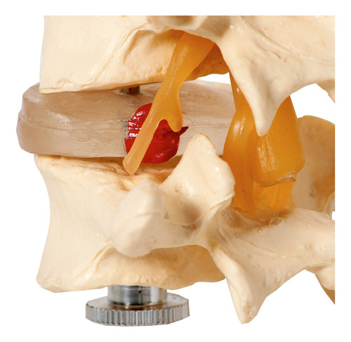 4 Vértebras Lombares Discos Intervertebrais Medula Prolapso